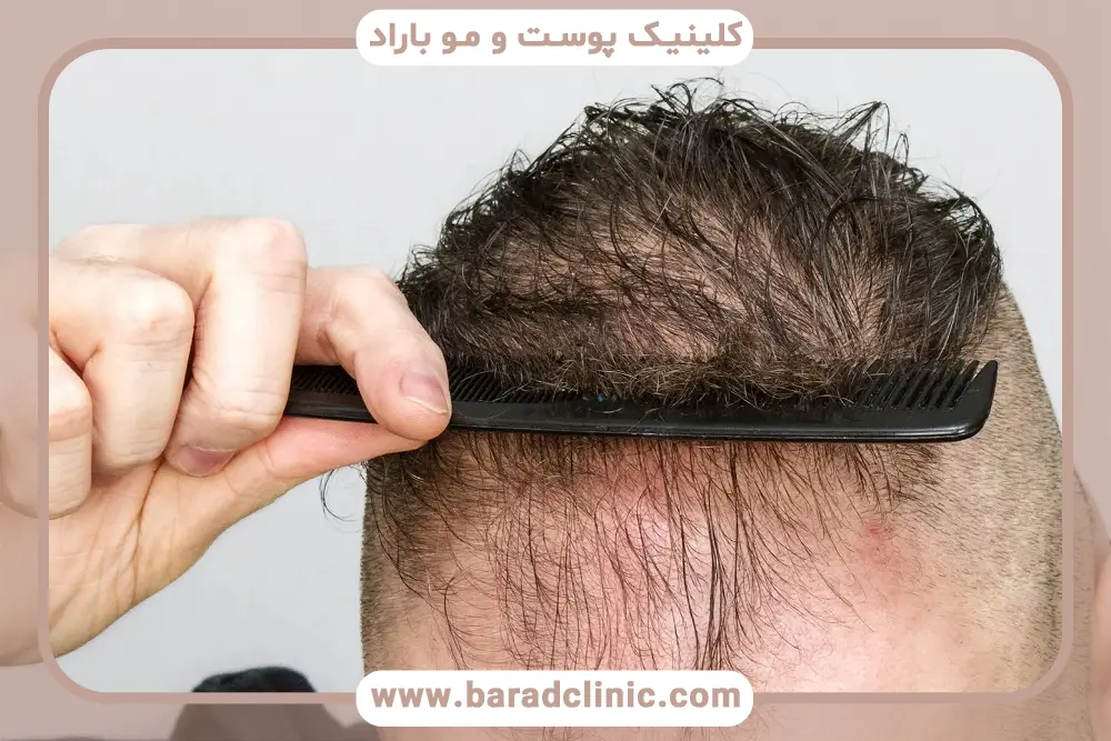 بررسی علت ریزش موی موقت