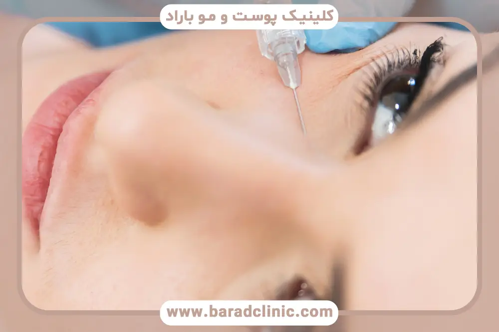 مراقبت بعد از مزوتراپی زیر چشم برای کاهش تورم