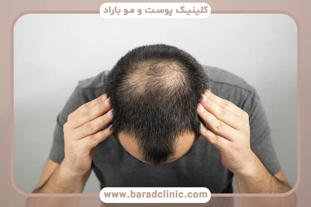 کمک به تصمیمگیری با عکس پشت سر بعد از کاشت مو