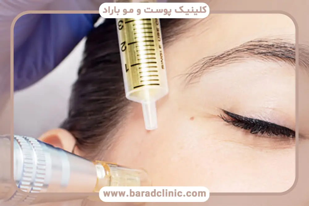 بهبود بافت پوست از فواید مزوتراپی