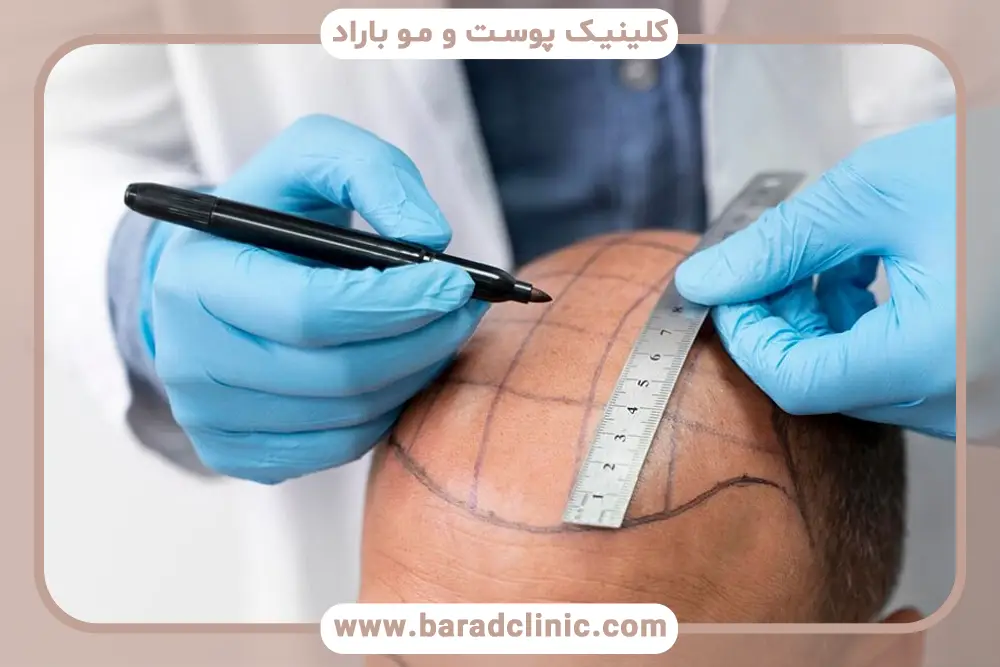 عوارض دائمی کاشت مو با نیدل چیست؟ آسیب به بانک مو