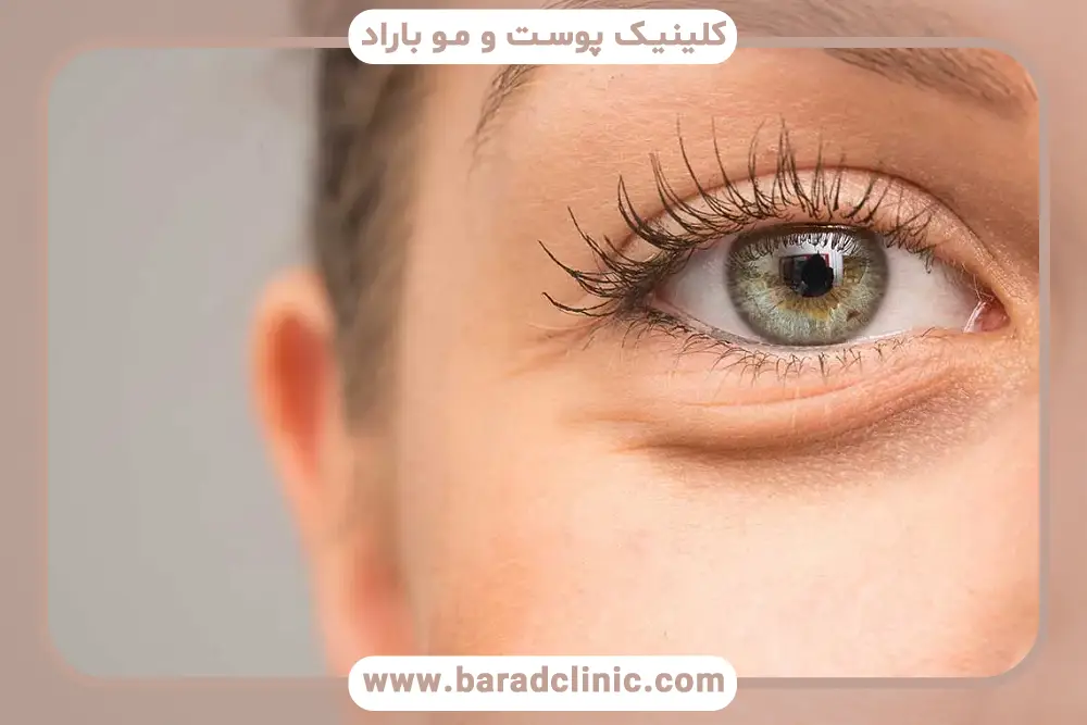 عوامل ایجاد پف زیر چشم چیست