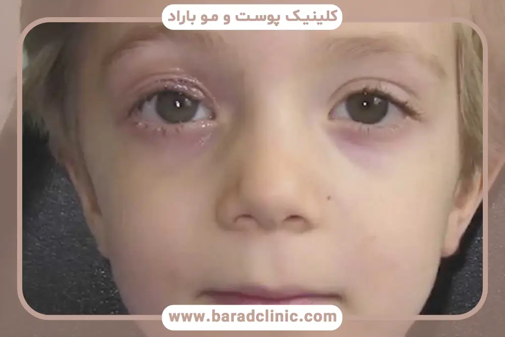 زمان مراجعه به پزشک برای پتوز مادرزادی پلک 