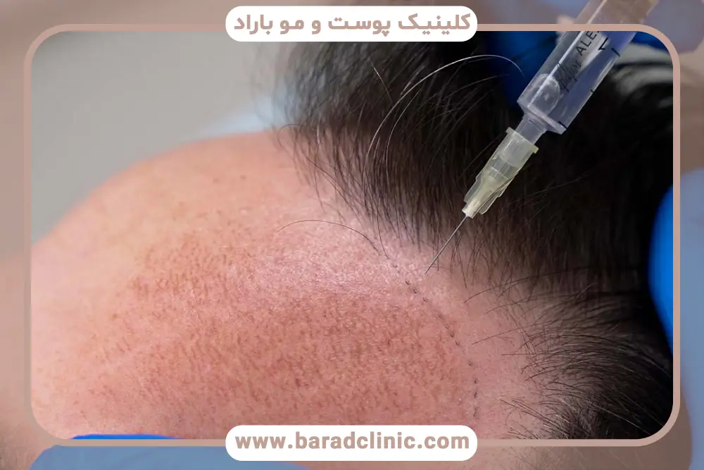 انتخاب رنگ نیدل برای نواحی مختلف سر