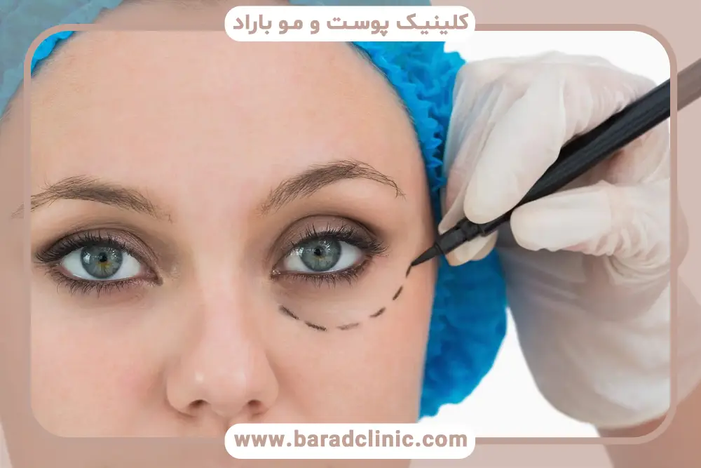 مقایسه انواع روش جدید بلفاروپلاستی