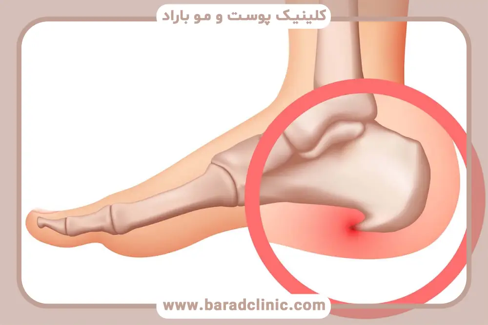 تعداد جلسات پی‌آر‌پی برای خار پاشنه 