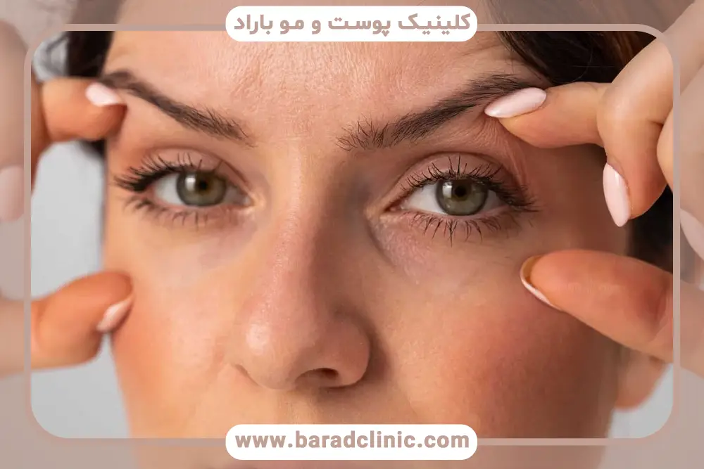 تشخیص افتادگی پلک یک طرفه 