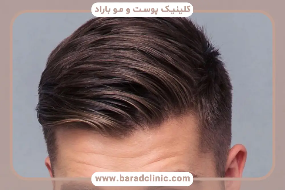 نکات قبل از کاشت مو به روش sut در تهران 
