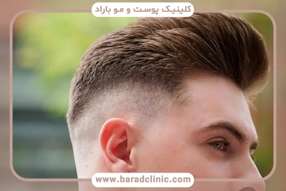 مراقبت‌های بعد از کاشت مو به روش sut با دستگاه اتوماتیک بدون جراحی
