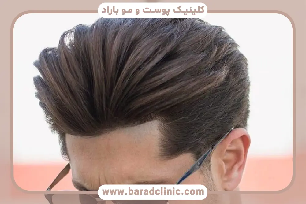 فاصله کاشت مو مجدد با کاشت موی ابتدایی