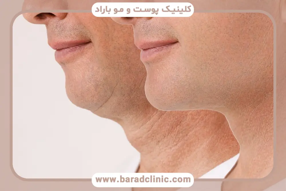 بررسی ارزش هزینه ی مزوتراپی غبغب 