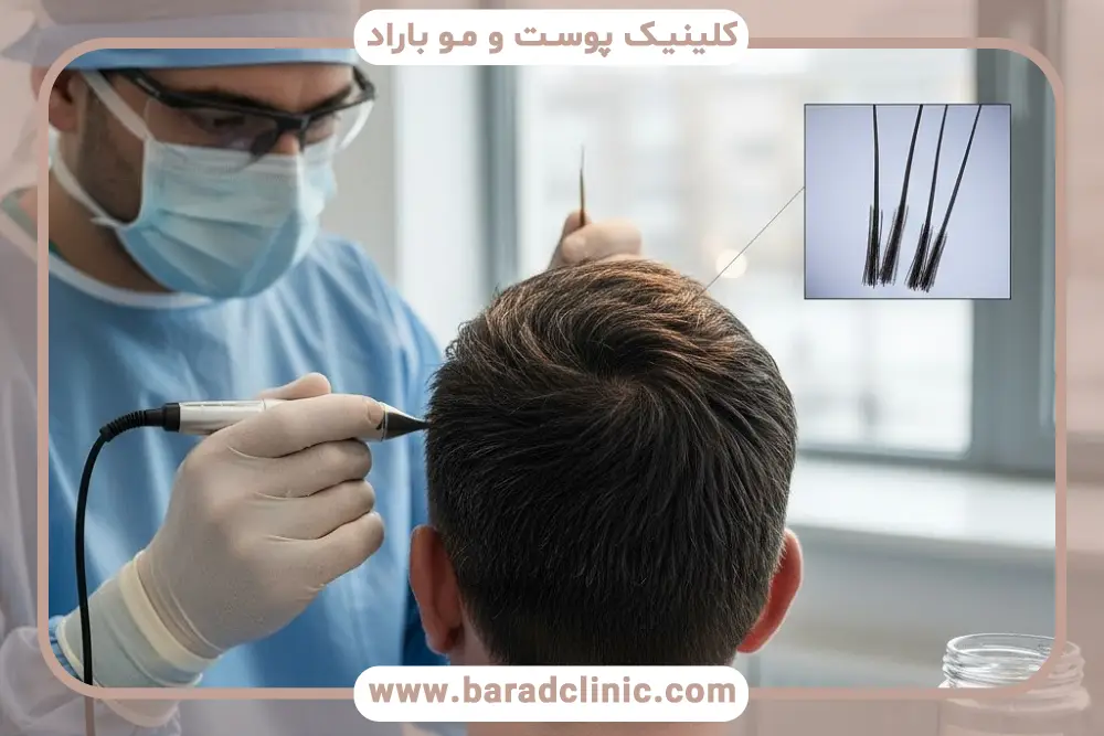 عوارض برداشت بیش از حد از بانک مو