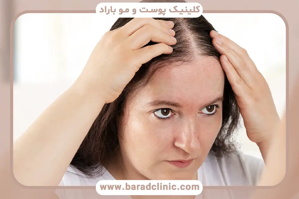 راهکارهای درمان طاسی زنانه (الگوی لودویگ) 