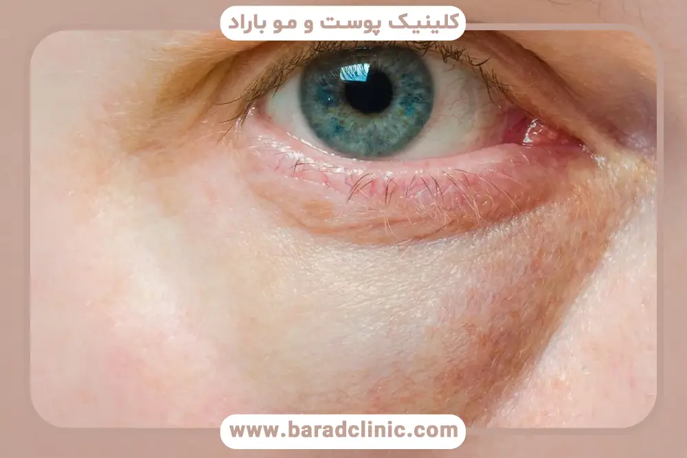 روش تشخیص کیسه چربی زیر چشم