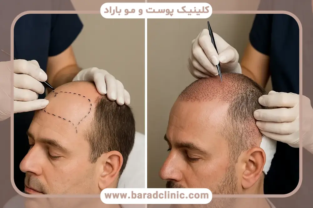 بررسی مراقبتهای بعد از کاشت مو