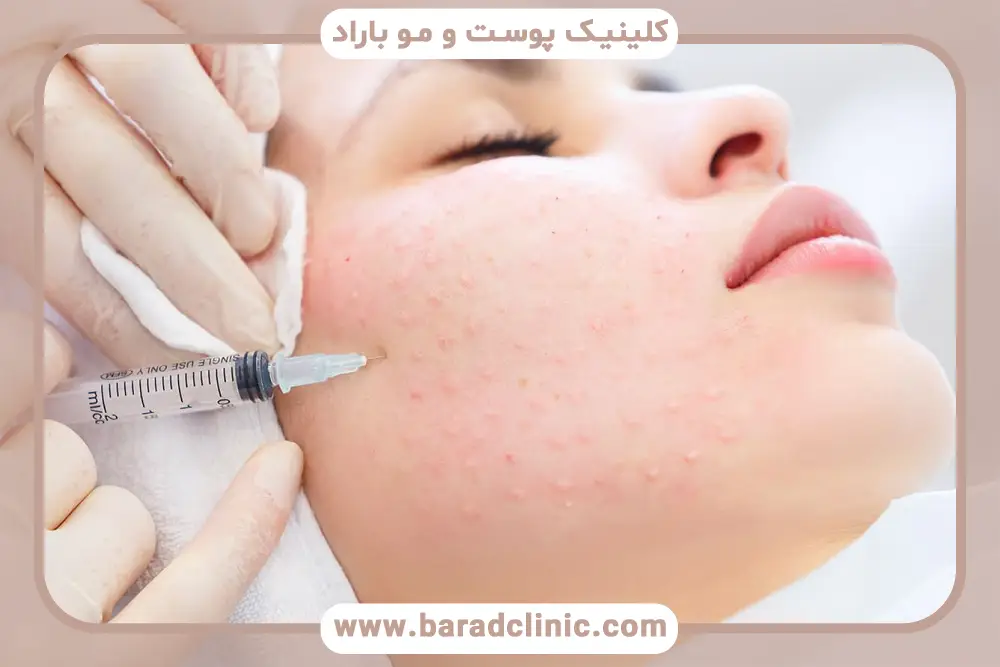 کاهش اسکارهای سطحی پوست با مزوتراپی