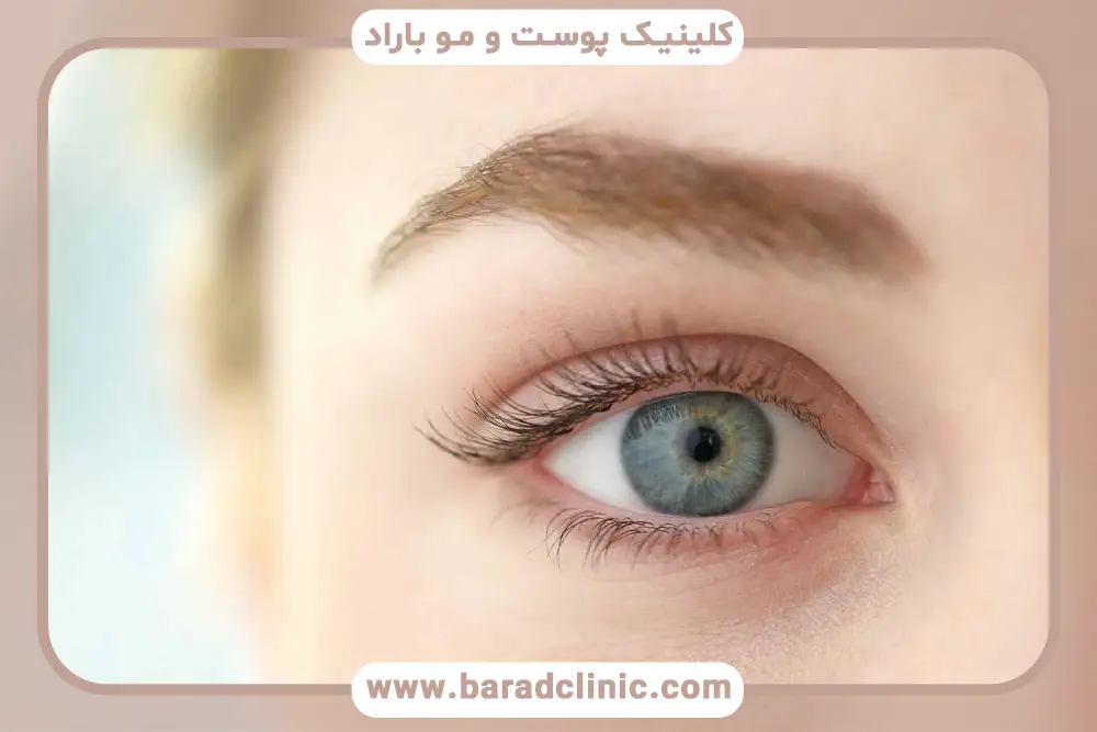 روش‌های درمان پف زیر چشم چیست