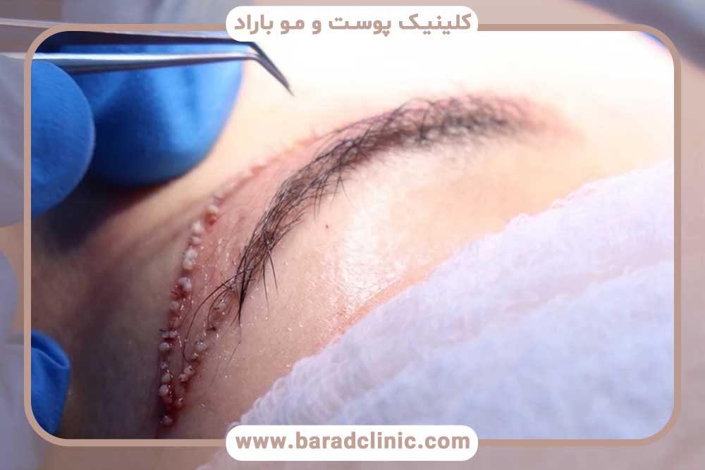 کاشت ابرو به روش FIT