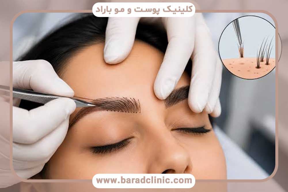 فیلم کاشت ابرو بدون جراحی