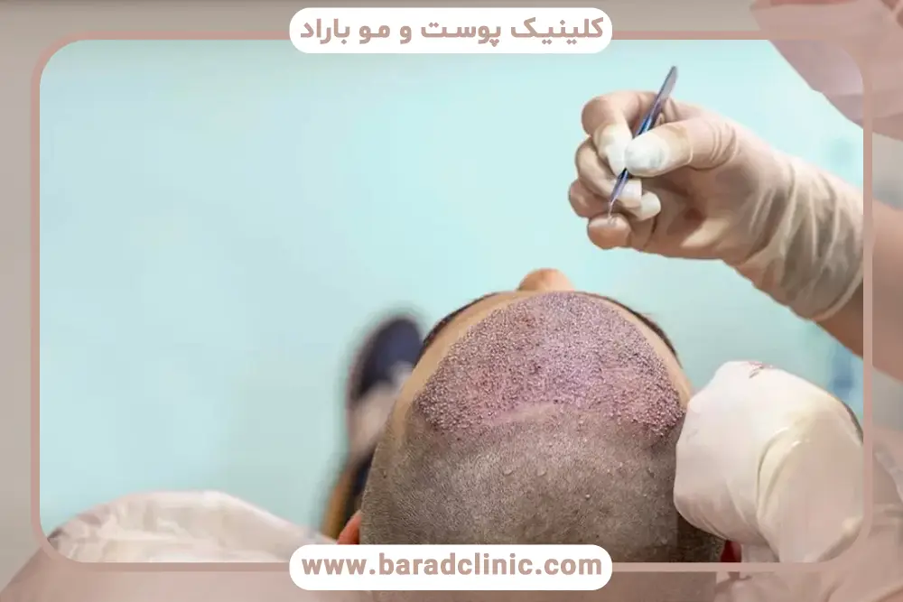 کاشت مو با نیدل چقدر درد دارد؟