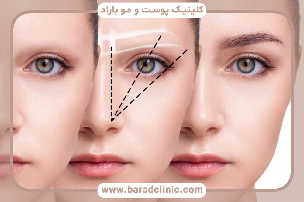 فیلم کاشت ابرو با جراحی