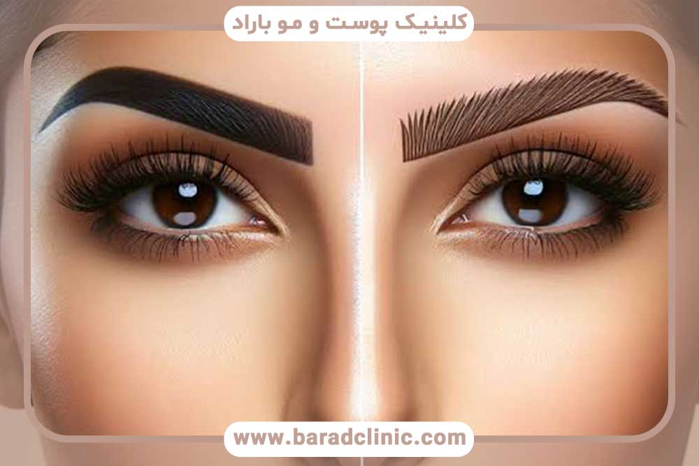 تفاوت میکروبلیدینگ و میکروپیگمنتیشن
