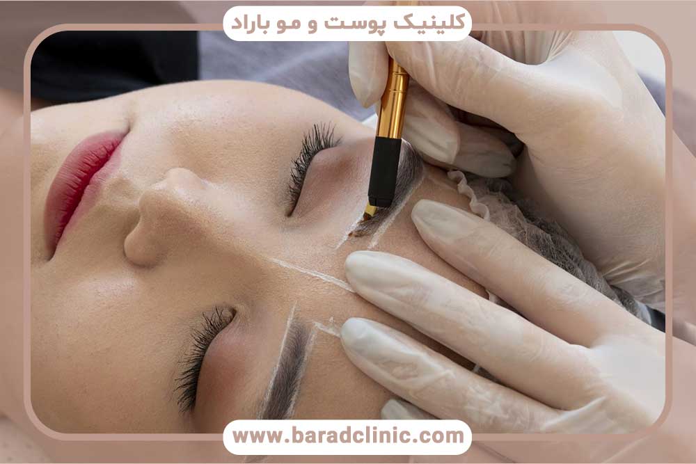 فرق کاشت ابرو با فیبروز ابرو