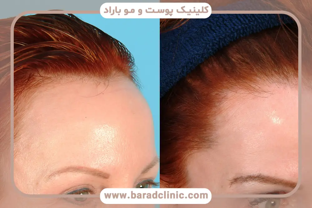 هزینه کاشت مو در پیشانی زنان