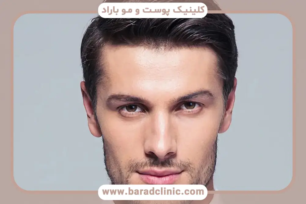 بانک مو برای کاشت ریش