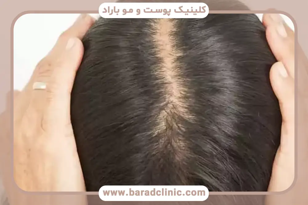 عوارض کاشت مو در زنان