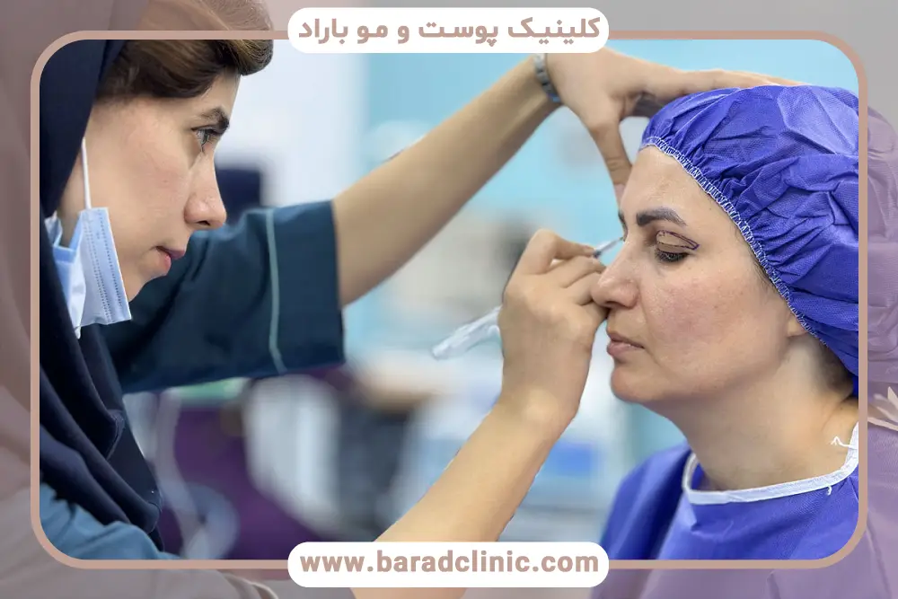عمل ناموفق بلفاروپلاستی