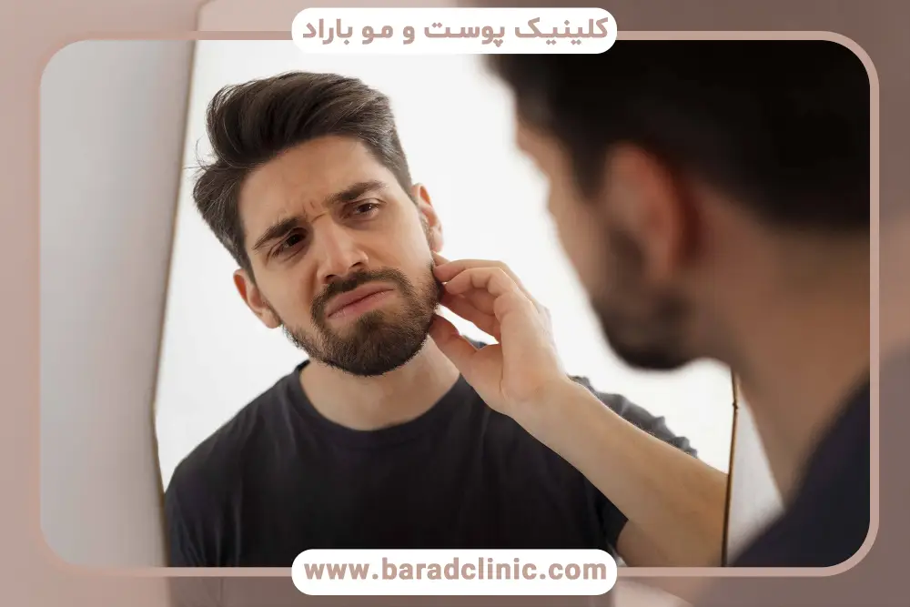 درمان ریزش ریش