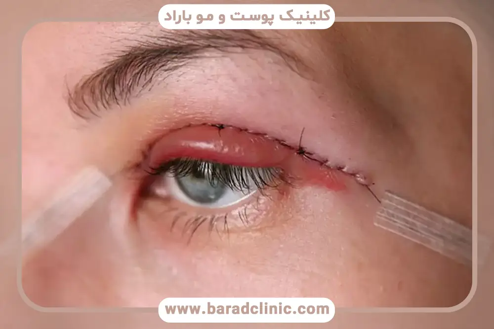 بلفاروپلاستی پلک بالا و پایین به صورت همزمان