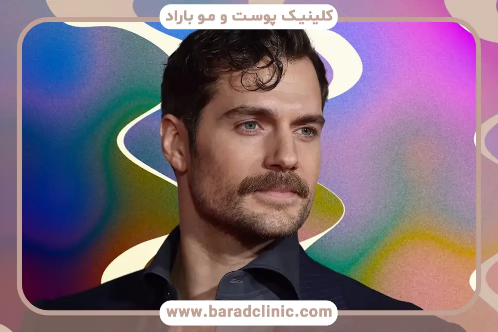 کاشت سبیل مردانه