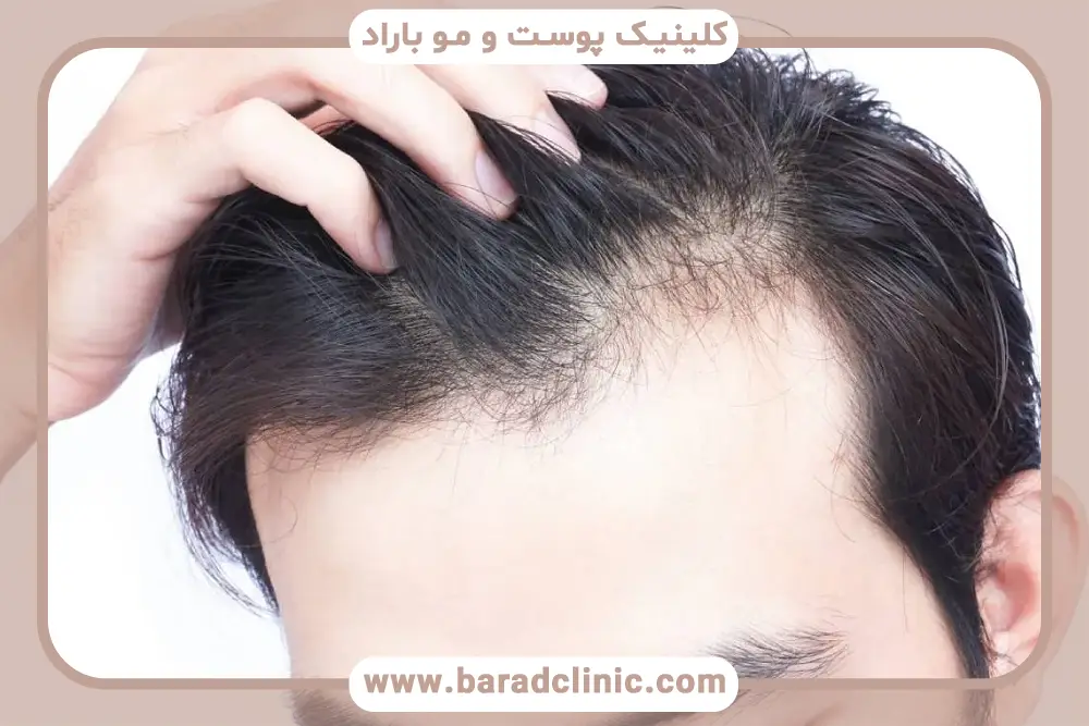 کدام ریزش مو خطرناک است؟