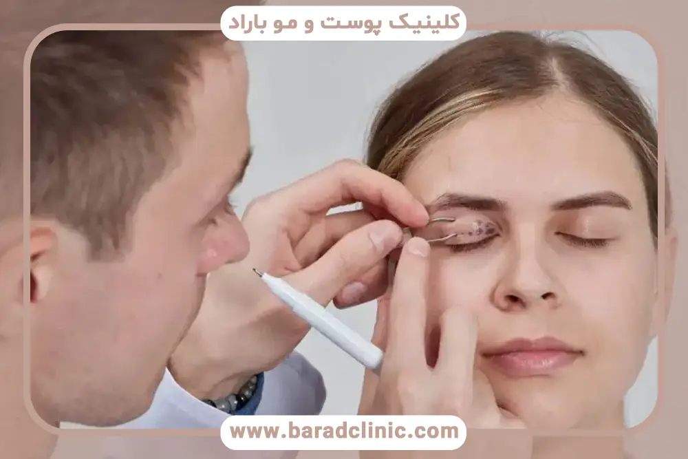 مراقبت های بعد از عمل بلفاروپلاستی
