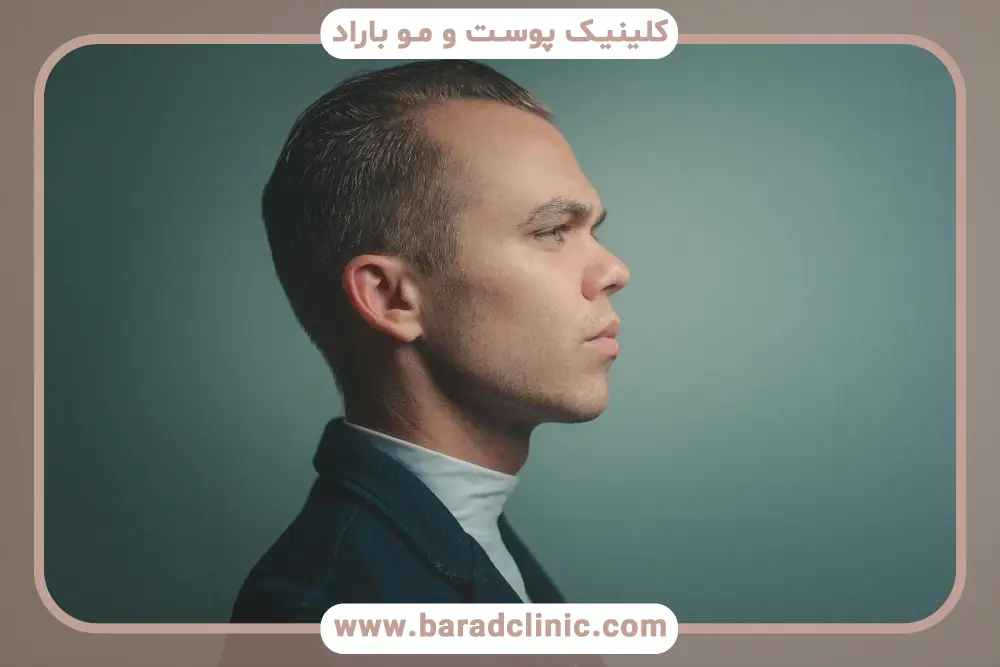 درمان ریزش مو از ریشه