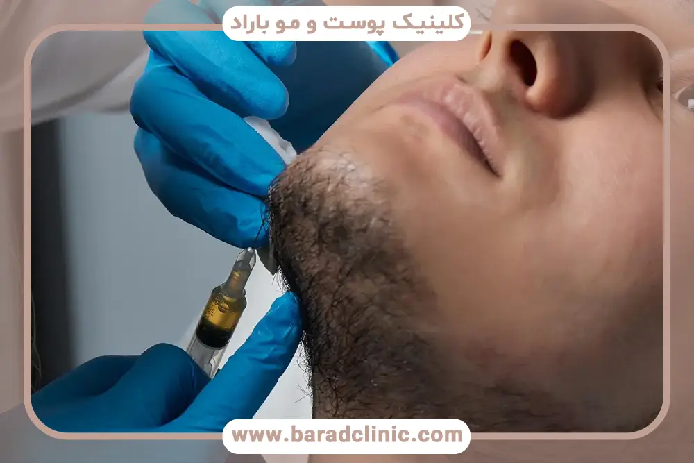 مزوتراپی ریش