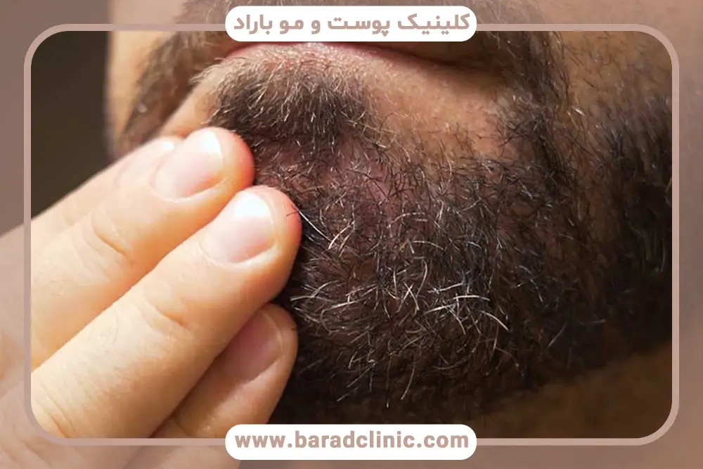 علت جوش های زیر ریش