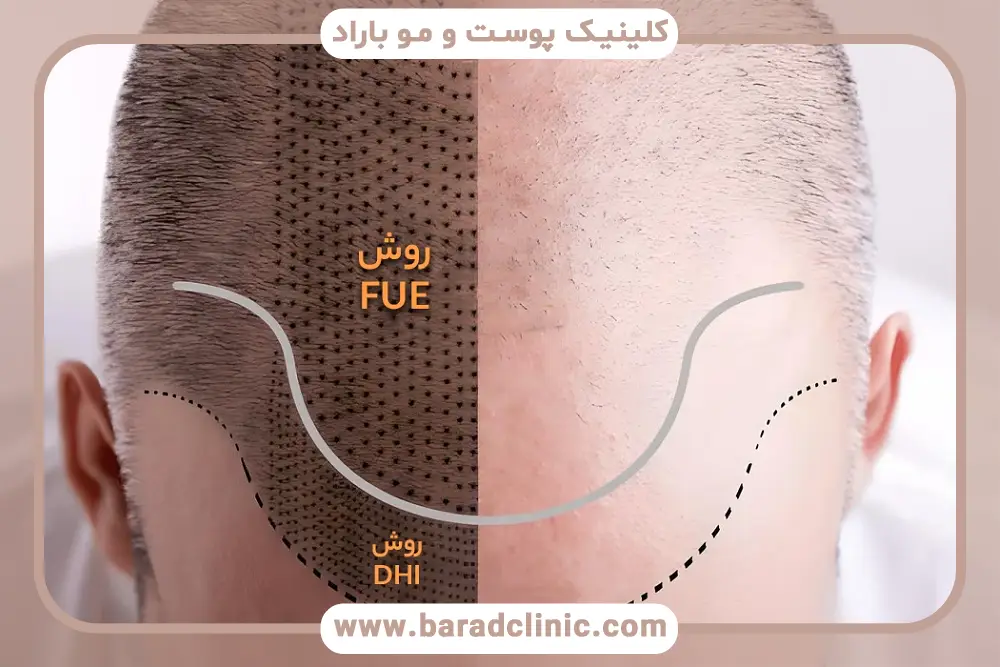 آخرین روش کاشت مو