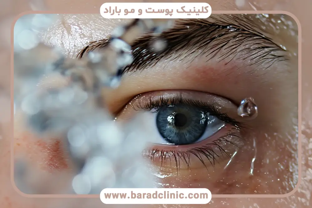 بعد از عمل بلفاروپلاستی کی حمام کنیم؟