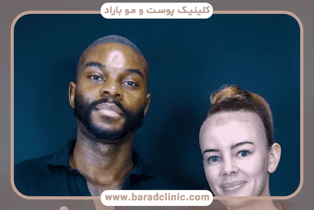 هزینه کاشت مو برای زنان