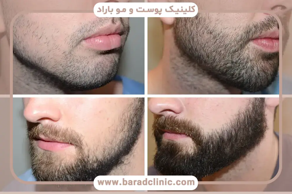 کاشت ریش درد دارد