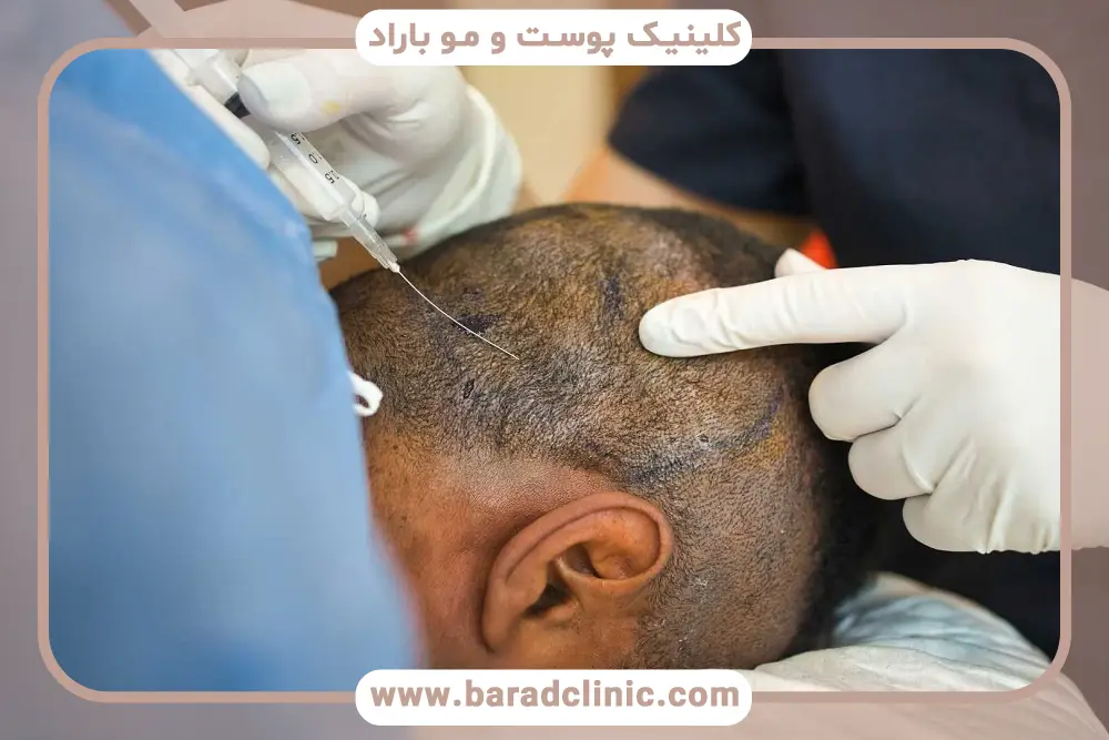 هزینه کاشت مو لیزری