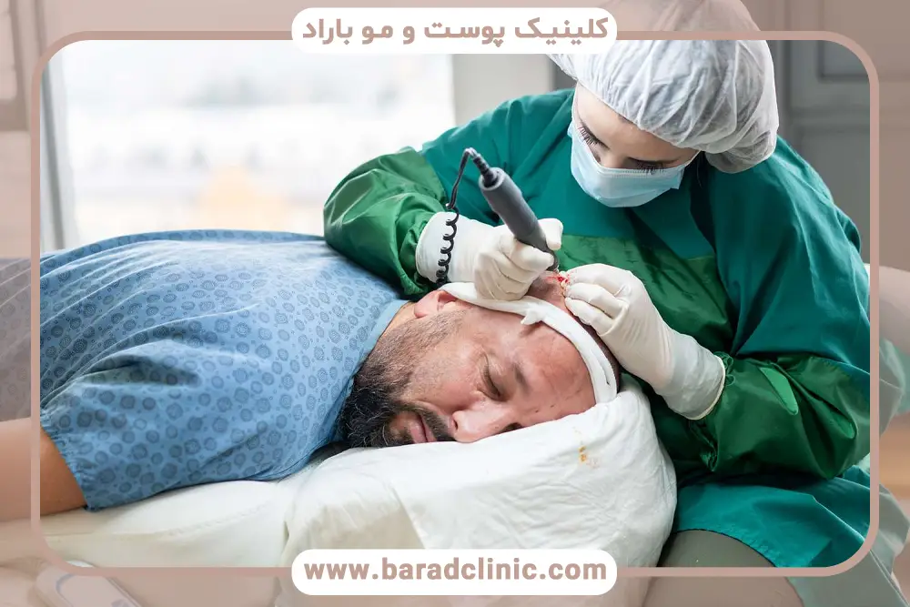 کاشت مو با نیدل بهتر است یا FUE