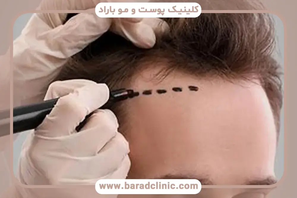 هزینه کاشت مو شقیقه