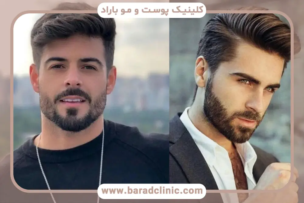 رشد ریش بعد از کاشت