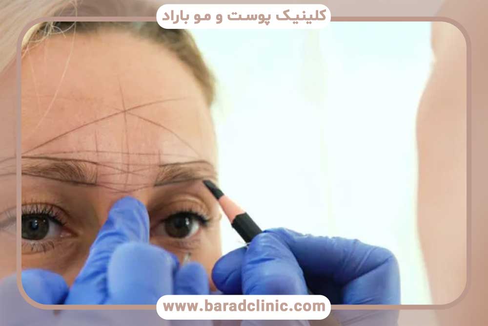 مراحل کاشت ابرو به روش FIT