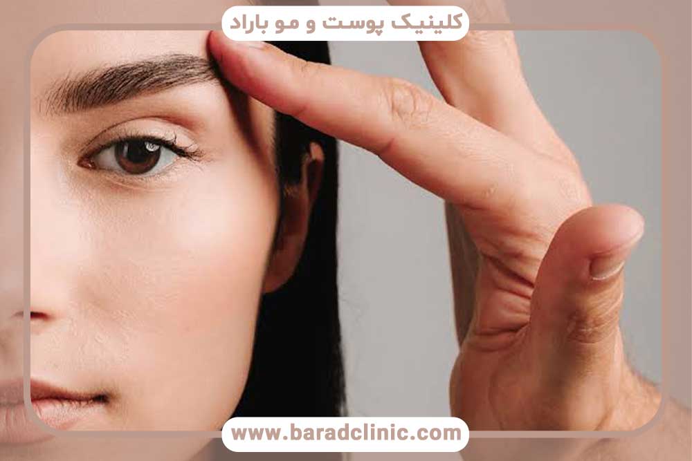 کاشت ابرو بدون جراحی