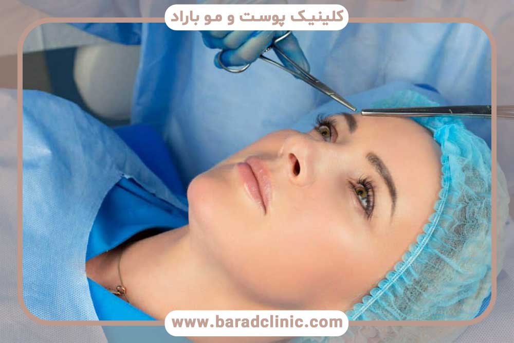 کاشت ابرو با جراحی
